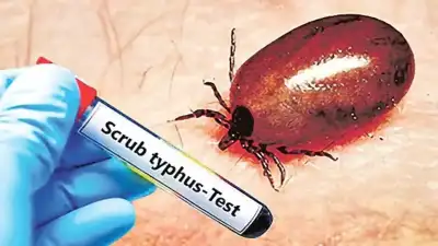 Scrub typhus has raised concerns in Odisha’s Sundargarh district following the reported death 