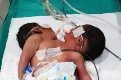 Conjoined twins die after seven days of treatment At MKCG hospital
