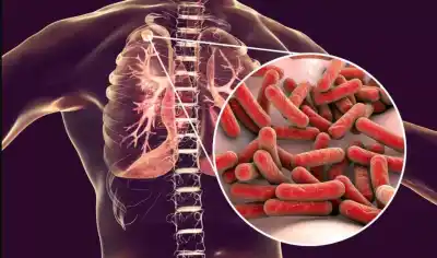 World Tuberculosis Day: Pollution, malnutrition behind rising TB cases