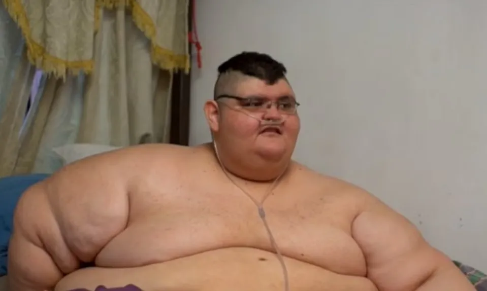 Advanced endoscopic procedure delivers stronger short-term weight loss of obese people 