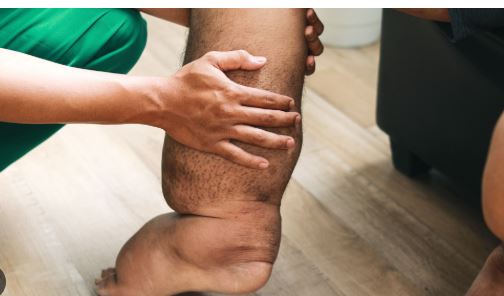 Odisha Govt to launch state-wide 'Filariasis Elimination Campaign' from February 10