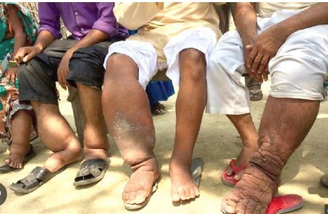 Nationwide campaign for 'Lymphatic Filariasis Elimination' launched