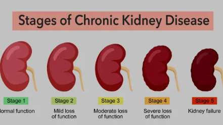 4 die every day due to kidney failure in Odisha: Why renal aliments growing in State in a BIG way? EXCLUSIVE