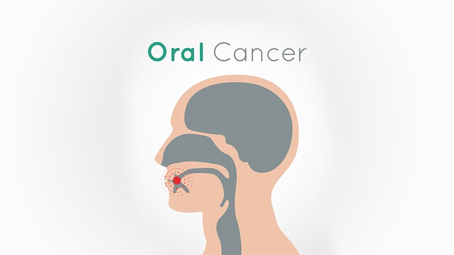 India's Oral cancer Crisis: A looming threat 