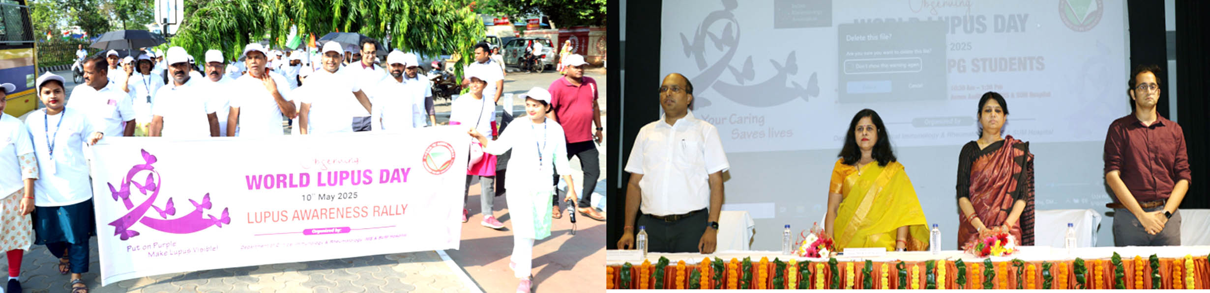 Proper diagnosis, timely treatment can cure lupus: Expert