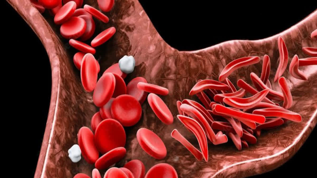 Sickle Cell disease growing concern in Odisha