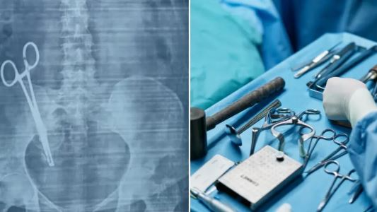Surgical scissors removed from woman’s stomach 17 years to her C-section 