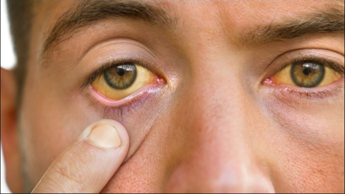 Jaundice Outbreak in BJB Nagar: 12 New Cases